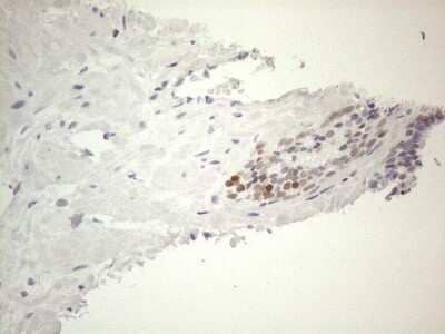 Immunohistochemistry: GATA-3 Antibody (OTI8H4) - Azide and BSA Free [NBP2-70796] - Analysis of Carcinoma of Human prostate tissue. (Heat-induced epitope retrieval by 1mM EDTA in 10mM Tris buffer (pH8.5) at 120C for 3 min)