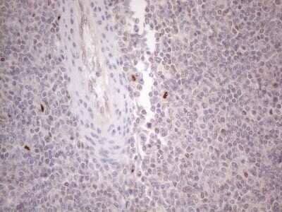 Immunohistochemistry: GATA-3 Antibody (OTI8H4) - Azide and BSA Free [NBP2-70796] - Analysis of Human lymphoma tissue. (Heat-induced epitope retrieval by 1mM EDTA in 10mM Tris buffer (pH8.5) at 120C for 3 min)