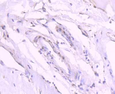 Immunohistochemistry-Paraffin: GATA-3 [p Ser308] Antibody (SC52-09) [NBP2-67496] - Analysis of paraffin-embedded human breast carcinoma tissue using anti-Phospho-GATA3(S308) antibody. Counter stained with hematoxylin.
