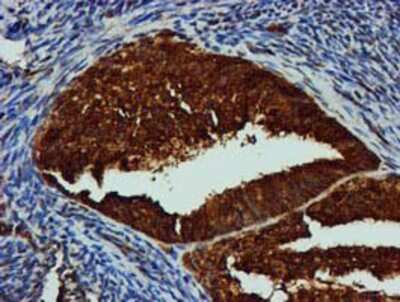 Immunohistochemistry-Paraffin: GATM Antibody (1E3) [NBP2-00984] - Staining of paraffin-embedded Adenocarcinoma of Human endometrium tissue using anti-GATM mouse monoclonal antibody.