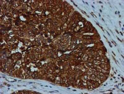 Immunohistochemistry-Paraffin: GATM Antibody (1E3) [NBP2-00984] - Staining of paraffin-embedded Adenocarcinoma of Human ovary tissue using anti-GATM mouse monoclonal antibody.