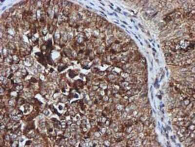 Immunohistochemistry-Paraffin: GATM Antibody (1E3) [NBP2-00984] - Staining of paraffin-embedded Carcinoma of Human bladder tissue using anti-GATM mouse monoclonal antibody.