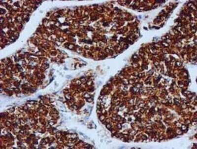 Immunohistochemistry: GATM Antibody (OTI1E3) - Azide and BSA Free [NBP2-70802] - Staining of paraffin-embedded Carcinoma of Human liver tissue using anti-GATM mouse monoclonal antibody.