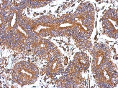 Immunohistochemistry-Paraffin: GBAS Antibody [NBP2-16617] - Human colon carcinoma, using GBAS antibody at 1:500 dilution. Antigen Retrieval: Trilogy™ (EDTA based, pH 8.0) buffer, 15min.