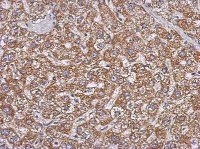 Immunohistochemistry-Paraffin: GBAS Antibody [NBP2-16618] - Immunohistochemical analysis of paraffin-embedded Hepatoma, using antibody at 1:500 dilution.