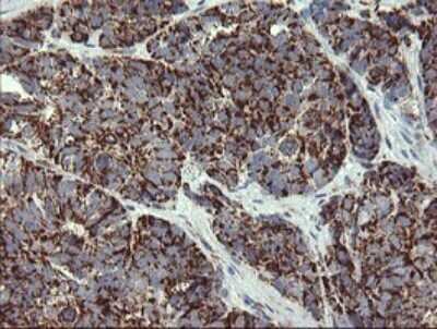 Immunohistochemistry: GBAS Antibody (OTI1B8) [NBP2-45730] - Analysis of Adenocarcinoma of Human ovary tissue. (Heat-induced epitope retrieval by 10mM citric buffer, pH6.0, 120C for 3min)