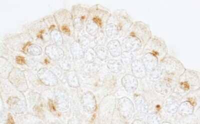 Immunohistochemistry: GBF1 Antibody [NBP1-06526] - Sample: FFPE section of human prostate carcinoma. Antibody: Affinity purified rabbit anti-GBF1 used at a dilution of 1:200 (1ug/ml). Detection: DAB