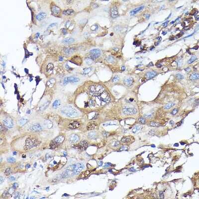 Immunohistochemistry-Paraffin: GBL Antibody [NBP3-03451] - Immunohistochemistry of paraffin-embedded human lung cancer using GBL Rabbit pAb (NBP3-03451) at dilution of 1:100 (40x lens). Perform high pressure antigen retrieval with 10 mM citrate buffer pH 6.0 before commencing with IHC staining protocol.