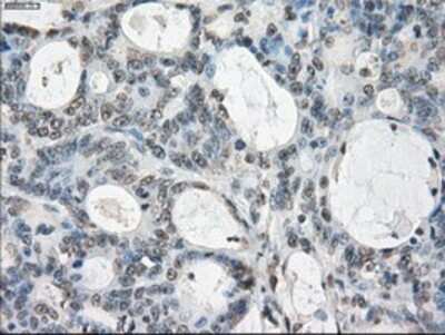 Immunohistochemistry-Paraffin: GBP2 Antibody (OTI5C8) [NBP1-47768] - Staining of paraffin-embedded Adenocarcinoma of Human colon tissue using anti-GBP2 mouse monoclonal antibody.