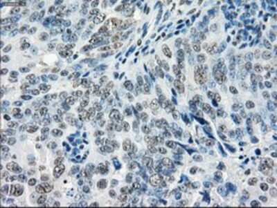 Immunohistochemistry-Paraffin: GBP2 Antibody (OTI5C8) [NBP1-47768] - Staining of paraffin-embedded Adenocarcinoma of Human ovary tissue using anti-GBP2 mouse monoclonal antibody.