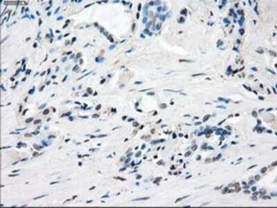 Immunohistochemistry-Paraffin: GBP2 Antibody (OTI5C8) [NBP1-47768] - Staining of paraffin-embedded Carcinoma of Human prostate tissue using anti-GBP2 mouse monoclonal antibody.