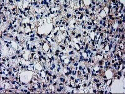 Immunohistochemistry: GCKR Antibody (OTI1E7) - Azide and BSA Free [NBP2-70823] - Staining of paraffin-embedded Carcinoma of Human kidney tissue using anti-GCKR mouse monoclonal antibody.