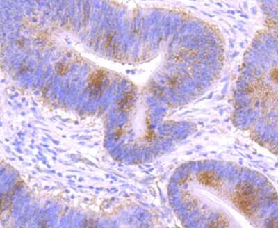 Immunohistochemistry-Paraffin: GCLM Antibody (JM93-61) [NBP2-75502] - Analysis of paraffin-embedded human colon cancer tissue using anti-GCLM antibody. Counter stained with hematoxylin.