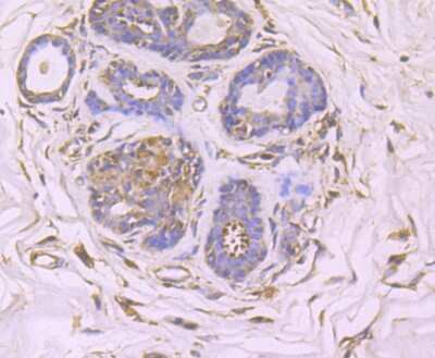 Immunohistochemistry-Paraffin: GCN2 Antibody (JA03-83) [NBP2-66865] - Analysis of paraffin-embedded human breast cancer tissue using anti-GCN2 antibody. Counter stained with hematoxylin.