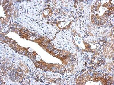 Immunohistochemistry-Paraffin: GCNT3 Antibody [NBP2-16626] - Human gastric cancer, using GCNT3 antibody at 1:500 dilution. Antigen Retrieval: Trilogy™ (EDTA based, pH 8.0) buffer, 15min.