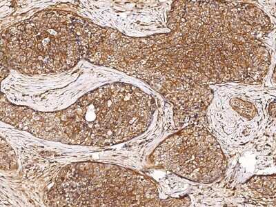 Immunohistochemistry-Paraffin: GDF-3 Antibody [NBP2-98686] - Immunochemical staining of human GDF-3 in human breast carcinoma with rabbit polyclonal antibody (1:1000, formalin-fixed paraffin embedded sections).