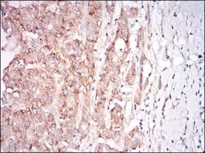 Immunohistochemistry-Paraffin: GDF-8/Myostatin Antibody (6E4B2) [NBP2-37260] - Aalysis of  liver cancer tissues using MSTN mouse mAb with DAB staining.