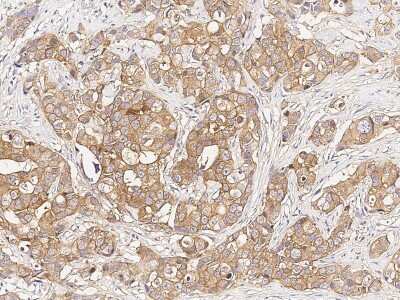 Immunohistochemistry-Paraffin: GDI1 Antibody [NBP2-99205] - Immunochemical staining of human GDI1 in human gastric cancer with rabbit polyclonal antibody (1:2000, formalin-fixed paraffin embedded sections).