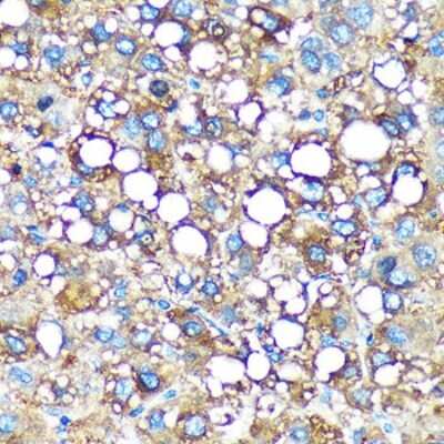 Immunohistochemistry-Paraffin: GEM Interacting Protein Antibody [NBP3-03540] - Immunohistochemistry of paraffin-embedded Human liver cancer using GEM Interacting Protein Rabbit pAb (NBP3-03540) at dilution of 1:100 (40x lens). Perform microwave antigen retrieval with 10 mM PBS buffer pH 7.2 before commencing with IHC staining protocol.