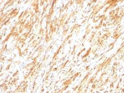 Immunohistochemistry-Paraffin: GFAP Antibody (SPM248) - Azide and BSA Free [NBP2-34401] - Formalin-fixed, paraffin-embedded human Schwannoma stained with GFAP monoclonal antibody (SPM248)