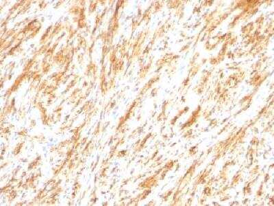 Immunohistochemistry-Paraffin: GFAP Antibody (SPM248) [NBP2-34353] - Formalin-fixed, paraffin-embedded human schwannoma stained with GFAP monoclonal antibody (SPM248).