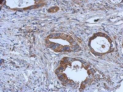 Immunohistochemistry-Paraffin: GGA1 Antibody [NBP2-16650] - Immunohistochemical analysis of paraffin-embedded Gastric ca, using antibody at 1:500 dilution.