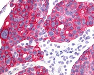 Immunohistochemistry-Paraffin: GHRHR Antibody [NLS834] - Analysis of anti-GHRHR antibody with human ovary, carcinoma.