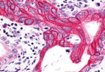 Immunohistochemistry-Paraffin: GHRHR Antibody [NLS834] - Anti-GHRHR antibody IHC of human Pancreas, Carcinoma. Immunohistochemistry of formalin-fixed, paraffin-embedded tissue after heat-induced antigen retrieval.