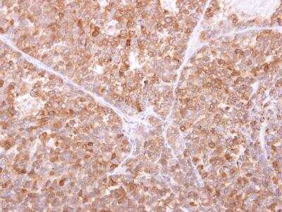 Immunohistochemistry-Paraffin: GILT/IFI30 Antibody [NBP1-32466] - AGS xenograft. GILT antibody dilution: 1:500. Antigen Retrieval: Trilogy™ (EDTA based, pH 8.0) buffer, 15min.