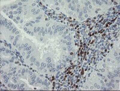 Immunohistochemistry: GIMAP4 Antibody (OTI1A11) - Azide and BSA Free [NBP2-71996] - Analysis of Adenocarcinoma of Human endometrium tissue.