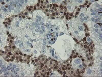 Immunohistochemistry: GIMAP4 Antibody (OTI1A11) - Azide and BSA Free [NBP2-71996] - Analysis of Adenocarcinoma of Human ovary tissue.