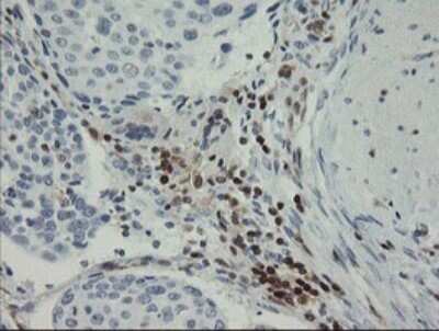 Immunohistochemistry: GIMAP4 Antibody (OTI1A11) - Azide and BSA Free [NBP2-71996] - Analysis of Carcinoma of Human bladder tissue.