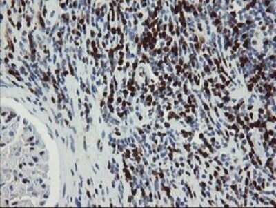 Immunohistochemistry: GIMAP4 Antibody (OTI1A11) - Azide and BSA Free [NBP2-71996] - Analysis of Carcinoma of Human kidney tissue.