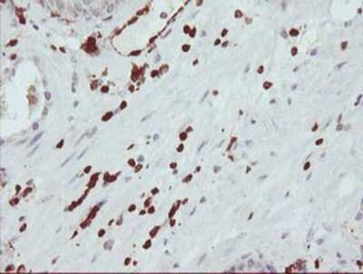 Immunohistochemistry: GIMAP4 Antibody (OTI1C6) - Azide and BSA Free [NBP2-71997] - Staining of paraffin-embedded Carcinoma of Human prostate tissue using anti-GIMAP4 mouse monoclonal antibody.