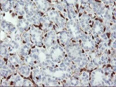 Immunohistochemistry: GIMAP4 Antibody (OTI1C6) - Azide and BSA Free [NBP2-71997] - Staining of paraffin-embedded Carcinoma of Human thyroid tissue using anti-GIMAP4 mouse monoclonal antibody.