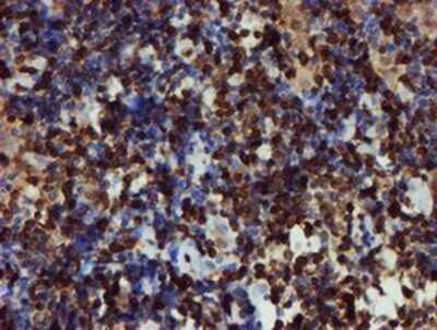 Immunohistochemistry: GIMAP4 Antibody (OTI1C6) - Azide and BSA Free [NBP2-71997] - Staining of paraffin-embedded Human lymphoma tissue using anti-GIMAP4 mouse monoclonal antibody.