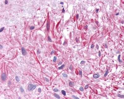 Immunohistochemistry-Paraffin: GIPR Antibody [NLS3842] - Analysis of anti-GIPR / GIP Receptor antibody with human brain, glioblastoma.