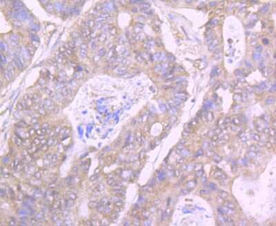 Immunohistochemistry-Paraffin: GIT1 Antibody (JU33-39) [NBP2-75505] - Analysis of paraffin-embedded human colon cancer tissue using anti-GIT1 antibody. Counter stained with hematoxylin.
