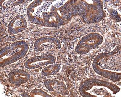 Immunohistochemistry-Paraffin: GIT1 Antibody (JU33-39) [NBP2-75505] - Analysis of paraffin-embedded human colon carcinoma tissue with Rabbit anti-GIT1 antibody washed with ddH2O and PBS, and then probed with the primary antibody at 1/400 dilution for 1 hour at room temperature. The detection was performed using an HRP conjugated compact polymer system. DAB was used as the chromogen. Tissues were counterstained with hematoxylin and mounted with DPX.