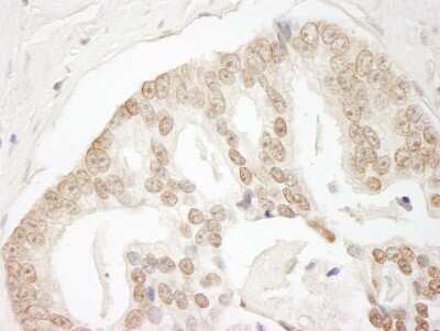 Immunohistochemistry: GIT2 Antibody [NBP1-19143] - Sample: FFPE section of human prostate carcinoma. Antibody: Affinity purified rabbit anti-GIT2 used at a dilution of 1:1,000 (1ug/ml). Detection: DAB