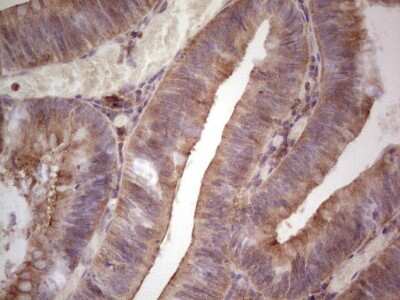 Immunohistochemistry: GITR/TNFRSF18 Antibody (9G8) [NBP2-46156] - Analysis of Adenocarcinoma of Human colon tissue.