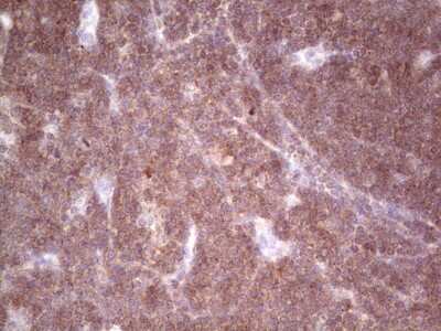 Immunohistochemistry: GITR/TNFRSF18 Antibody (9G8) [NBP2-46156] - Analysis of Human lymphoma tissue.