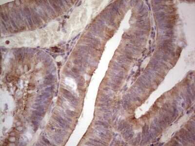 Immunohistochemistry: GITR/TNFRSF18 Antibody (OTI9G8) - Azide and BSA Free [NBP2-71388] - Analysis of Adenocarcinoma of Human colon tissue.