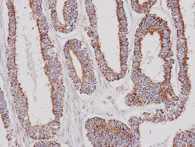 Immunohistochemistry-Paraffin: GK2 Antibody [NBP1-32210] - Paraffin-embedded OVCA xenograft, using antibody at 1:100 dilution.