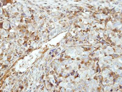 Immunohistochemistry-Paraffin: GK5 Antibody [NBP1-32863] - Paraffin-embedded CL1-0 xenograft, using antibody at 1:500 dilution.