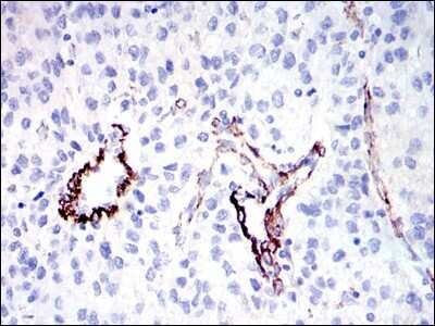 Immunohistochemistry: GKAP/DLGAP1 Antibody (3G4) [NBP2-37582] - Immunohistochemical analysis of paraffin-embedded human liver cancer tissues using GKAP mouse mAb with DAB staining.