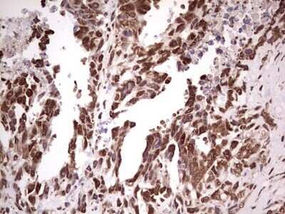 Immunohistochemistry: GLI-1 Antibody (OTI4E2) - Azide and BSA Free [NBP2-70831] - Analysis of Human testicular cancer tissue.(Heat-induced epitope retrieval by 1 mM EDTA in 10mM Tris, pH8.5, 120C for 3min)