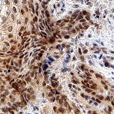 Immunohistochemistry-Paraffin: GLI-2 Antibody (524409) [Unconjugated] [MAB35262] - GLI-2 was detected in immersion fixed paraffin-embedded sections of human squamous cell carcinoma using Mouse Anti-Human GLI-2 Monoclonal Antibody (Catalog # MAB35262) at 5 ug/mL for 1 hour at room temperature followed by incubation with the Anti-Mouse IgG VisUCyte HRP Polymer Antibody (Catalog # VC001). Before incubation with the primary antibody, tissue was subjected to heat-induced epitope retrieval using Antigen Retrieval Reagent-Basic (Catalog # CTS013). Tissue was stained using DAB (brown) and counterstained with hematoxylin (blue). Specific staining was localized to cell nuclei. View our protocol for IHC Staining with VisUCyte HRP Polymer Detection Reagents.