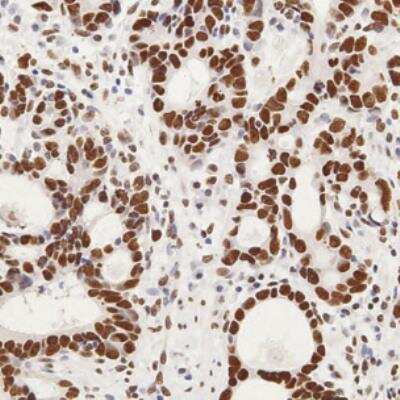 Immunohistochemistry-Paraffin: GLI-2 Antibody [NB600-874] - Mouse adenocarcinoma section shows high and diffuse nuclear Gli2 expression. IHC-P image submitted by a verified customer review.