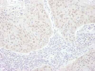 Immunohistochemistry-Paraffin: GLI-3 Antibody [NBP1-79019] - Sample: FFPE section of human lung cancer. Antibody: Affinity purified rabbit anti- GLI3 used at a dilution of 1:1,000 (1ug/ml). Detection: DAB